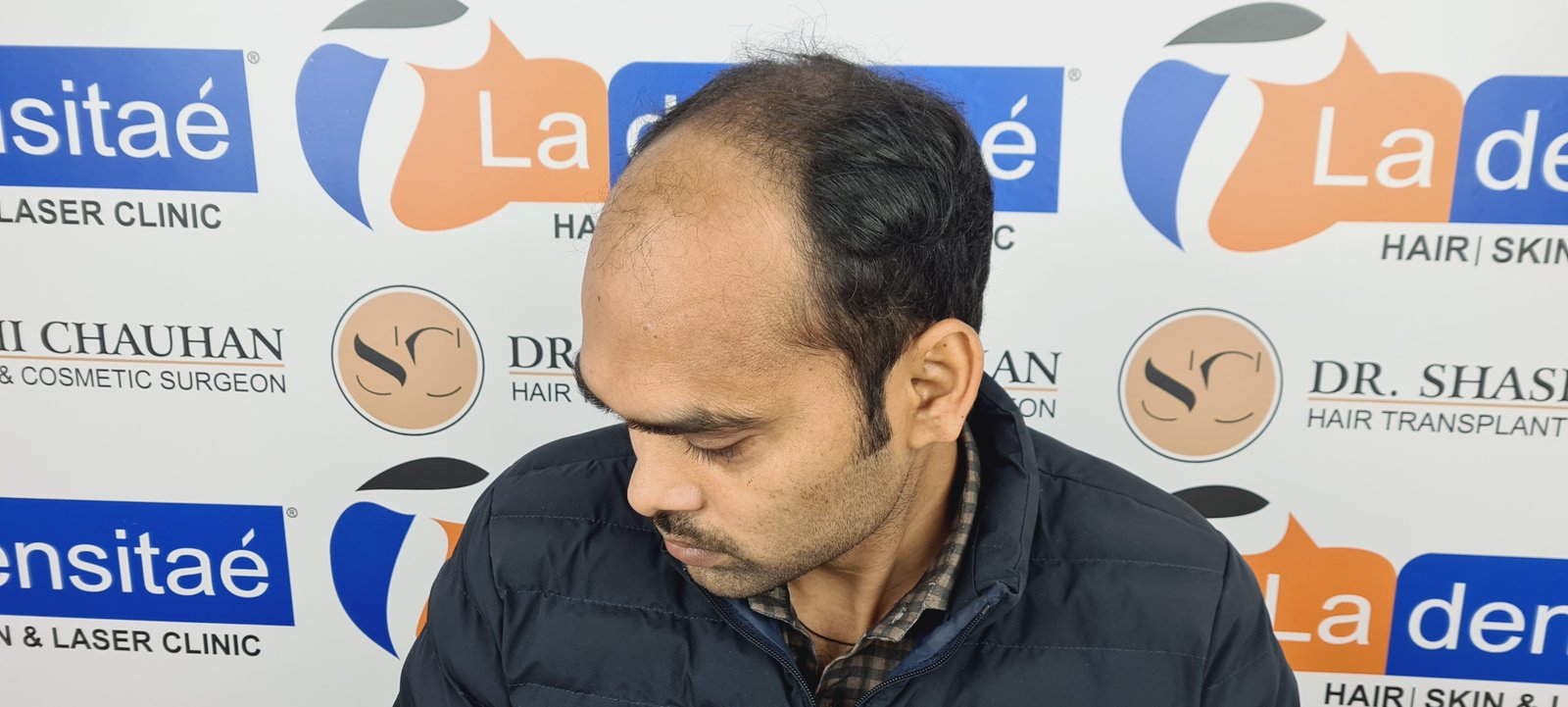 Anesh Kumar Before Hair Transplant